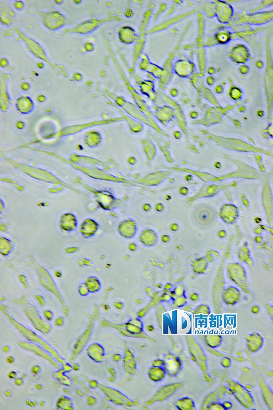 <p>    ↑目前临床应用最广泛的细胞生物治疗是C IK细胞治疗，在显微镜下可清晰看到D C细胞(叶片形状)和C IK细胞(圆点形状)。</p>